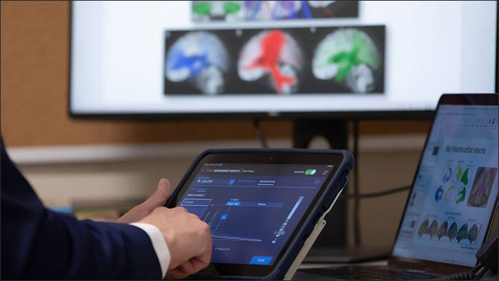 Mayo Clinic maps patients' brain waves to personalize epilepsy treatment