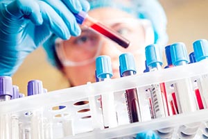 Blood test shows promise for detecting testicular cancer when standard markers m