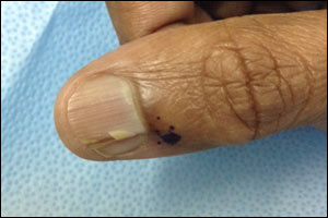 Rare tumour treated due to high clinical acumen of the Plastic Surgeon